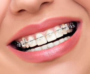 Braces-Damon