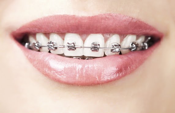What Do Braces Do to Your Teeth?