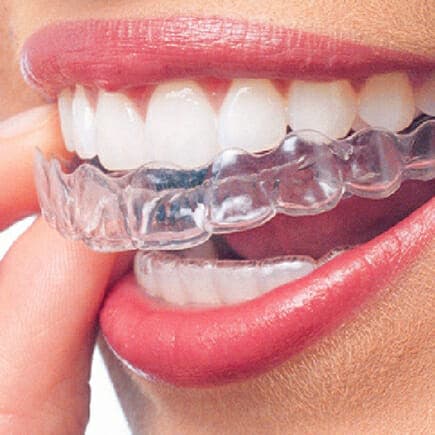 Invisalign®