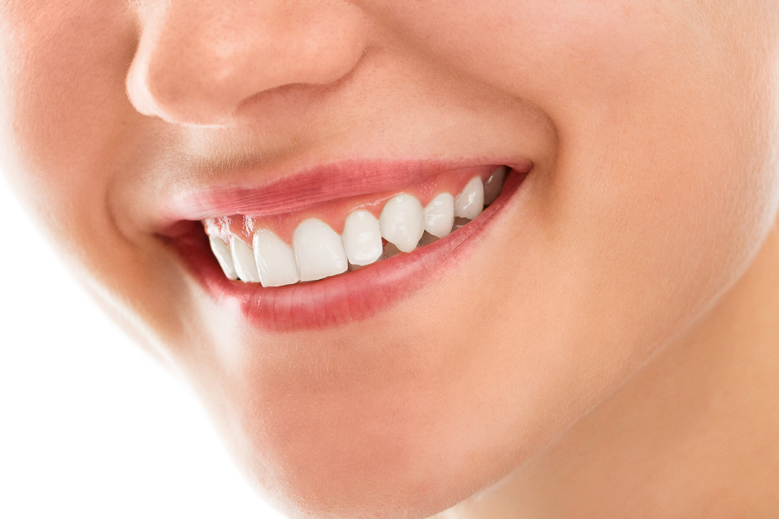 Self-Ligating (Damon™) Braces: The Smile You Deserve
