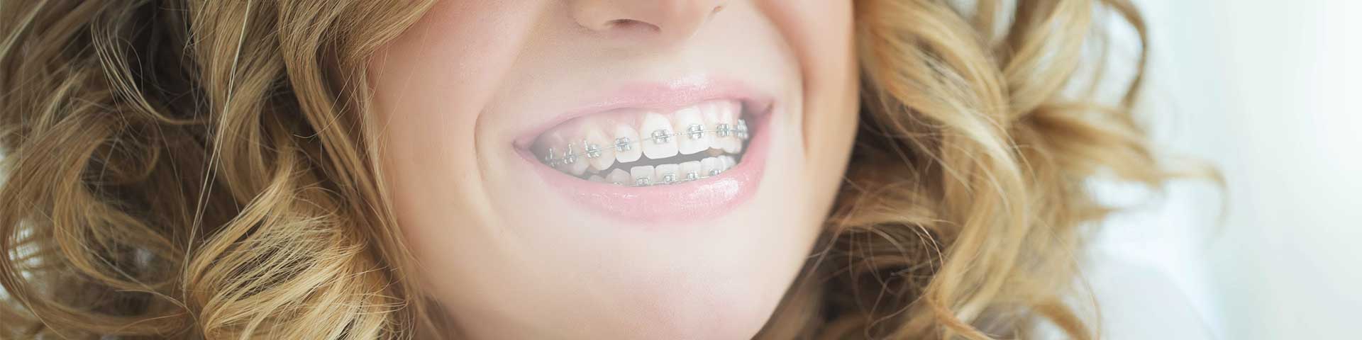 Damon™ Braces
