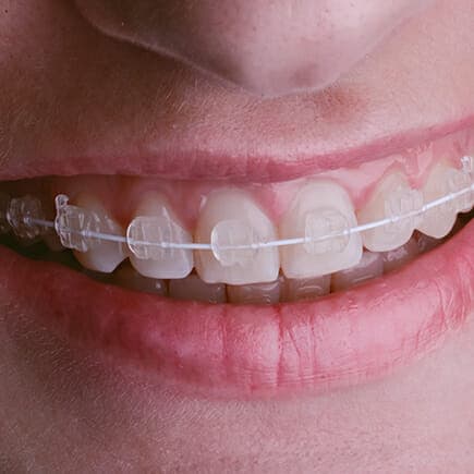 ceramic-braces