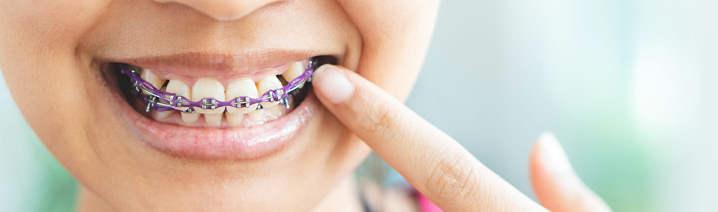 Metal Braces