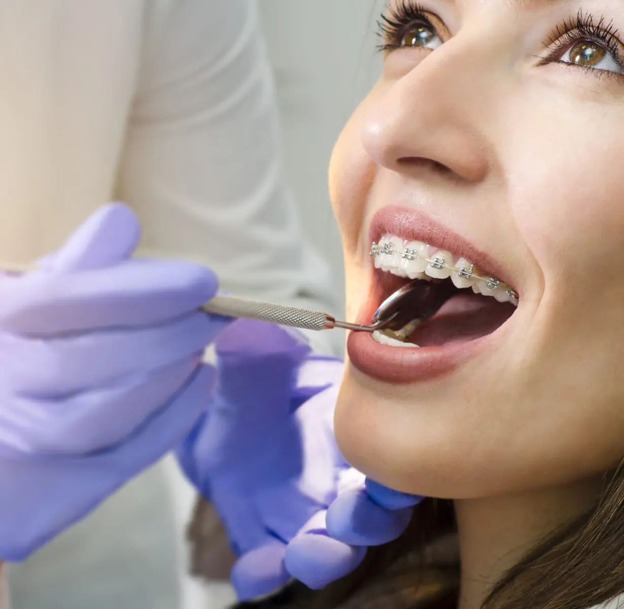 Ceramic Braces
