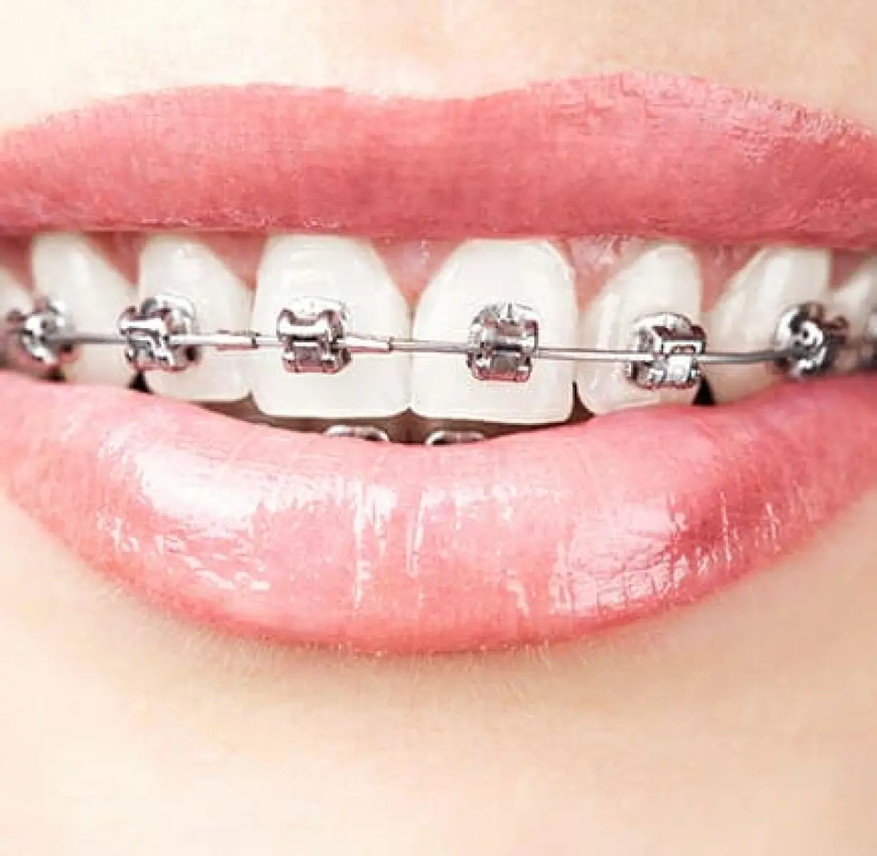 metal-braces