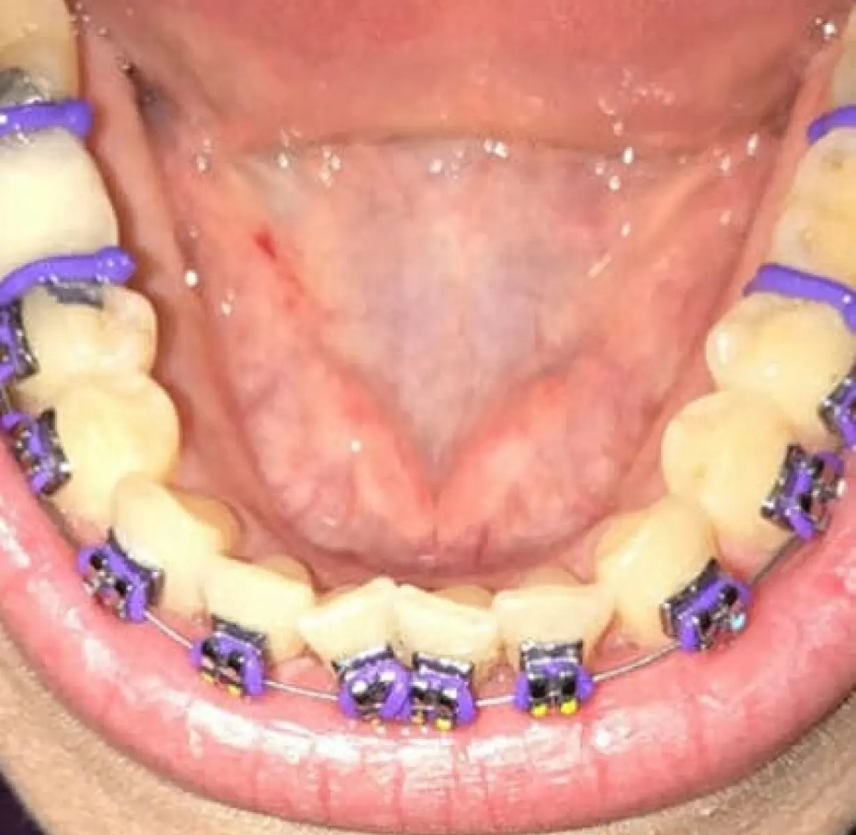 spacers
