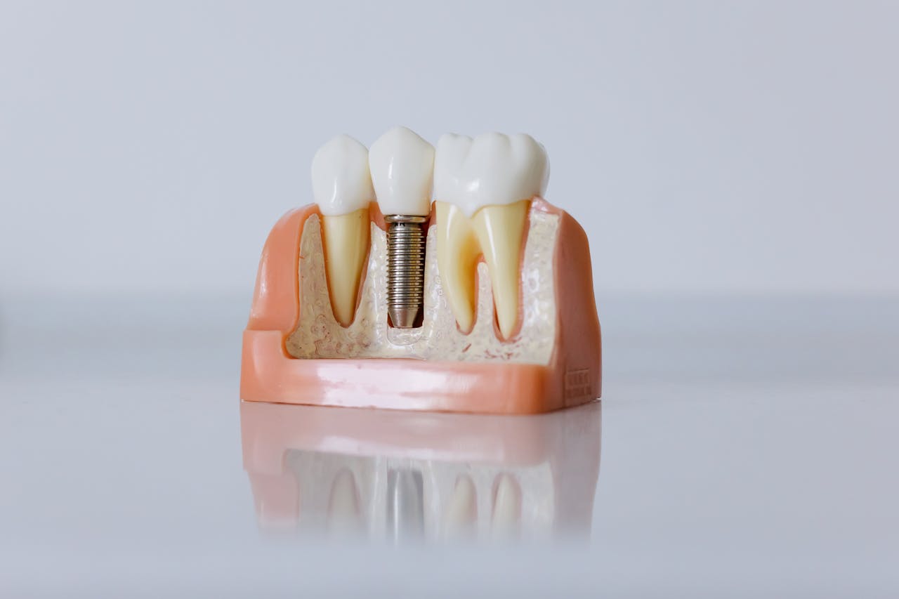 Dental Implant Model With A Crown Restoration And Artificial Tooth Root At Prosper Trail Orthodontics